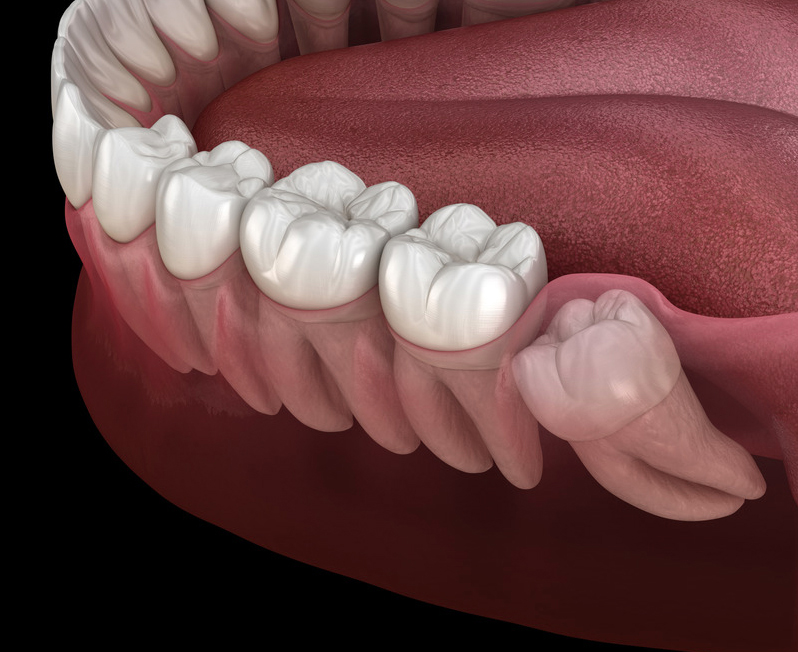 Wisdom Teeth