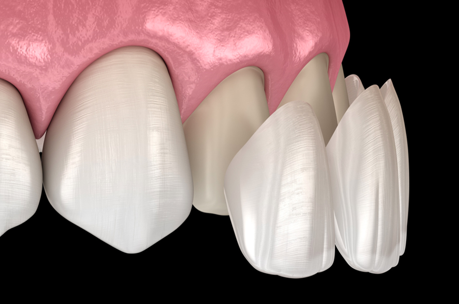 Veneers