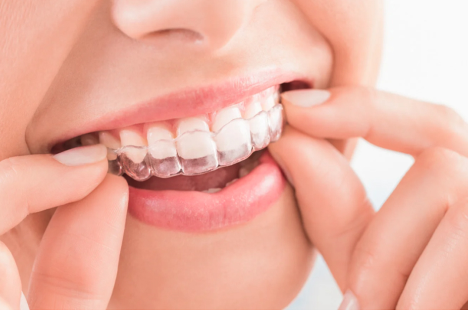 Retainers