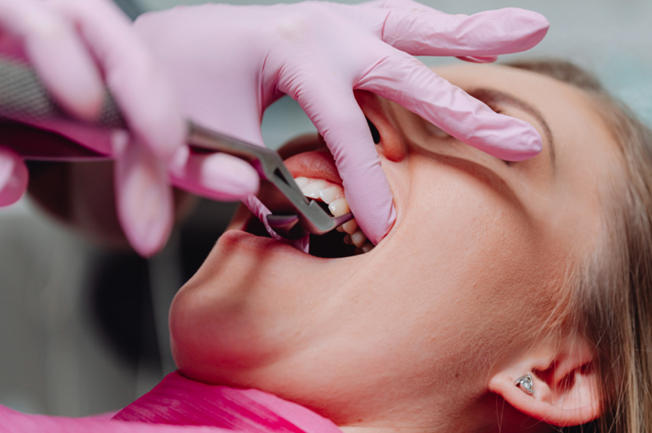 Extractions