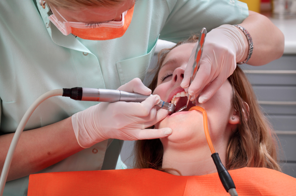 Composite White Fillings
