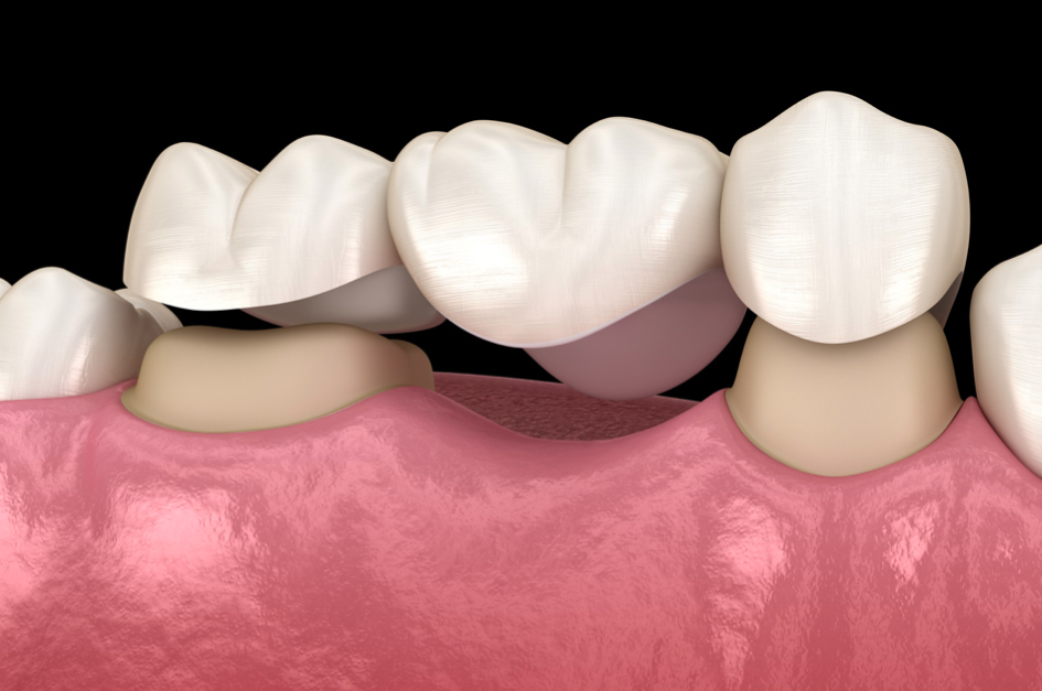 Missing Teeth
