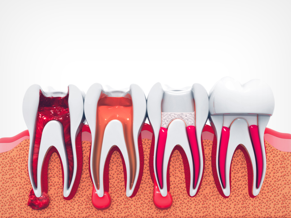 Root Canal Treatment